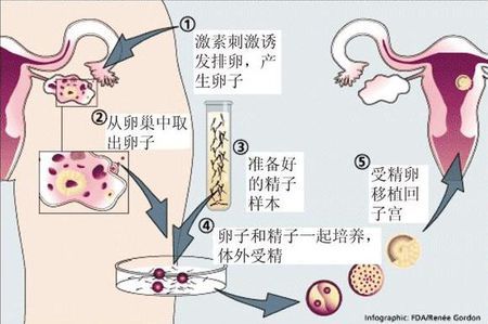卵子凍結保存
